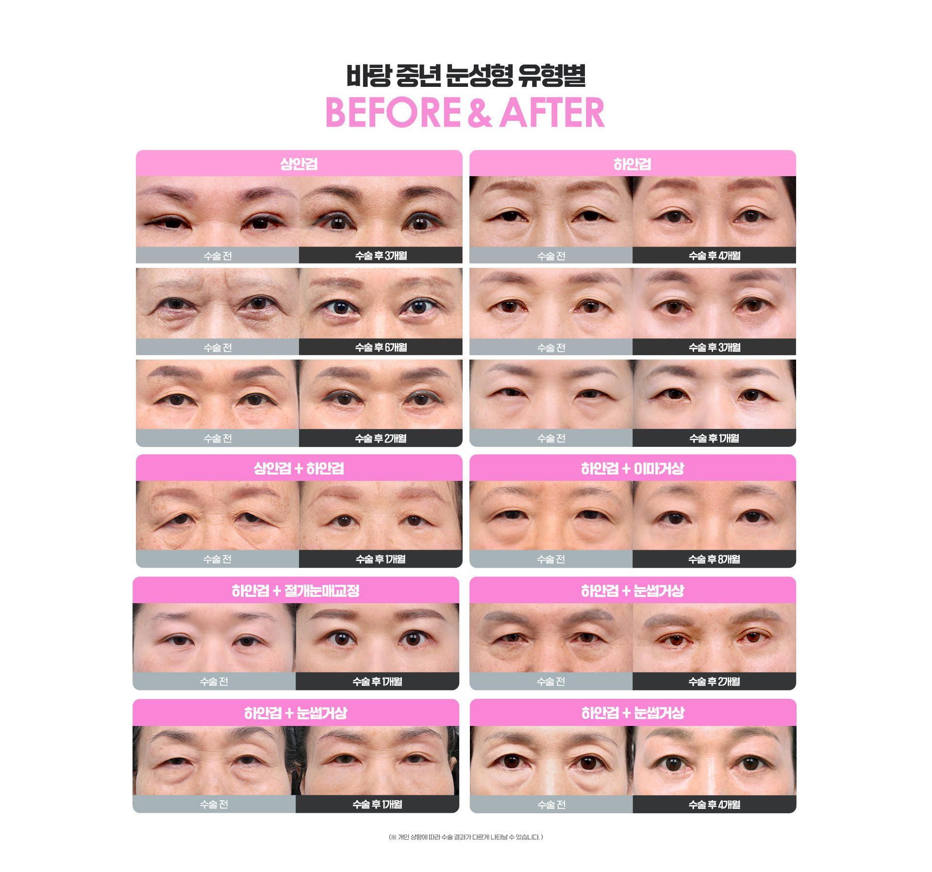 바탕중년눈성형전후