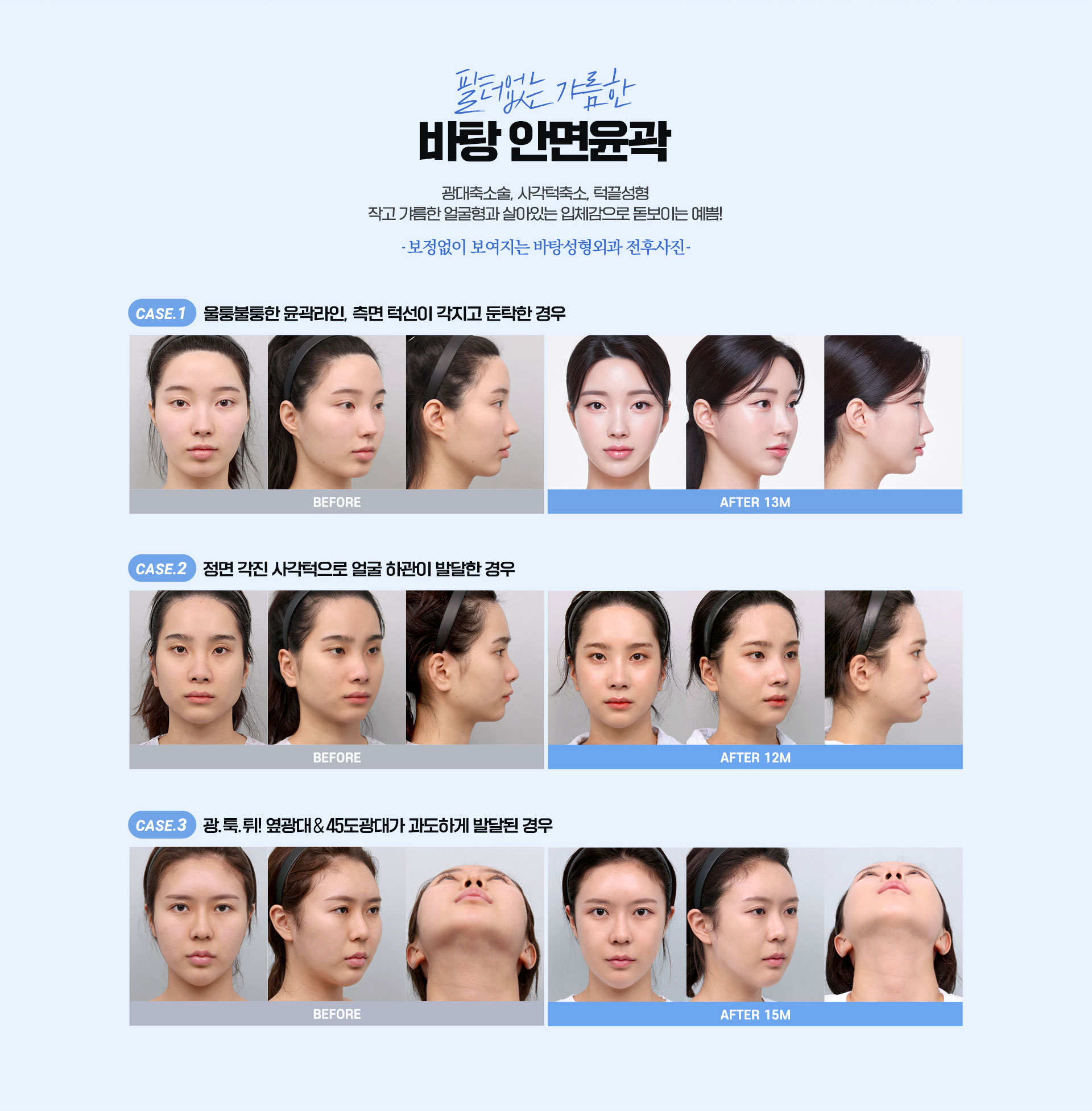 광대축소술, 사각턱축소, 턱끝성형, 안면윤곽, 바탕성형외과 전후사진