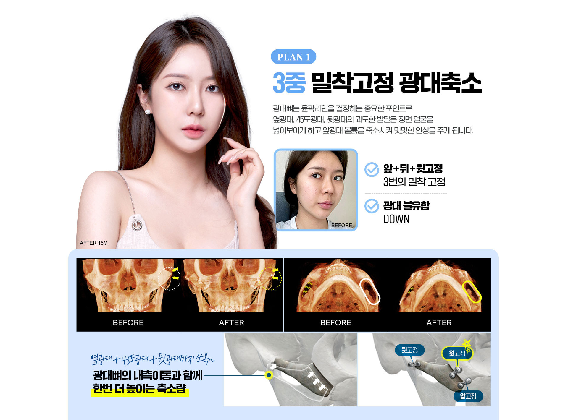 3중밀착고정광대축소, 필요한 만큼만 내측 이동, 3번의 광대뼈 고정