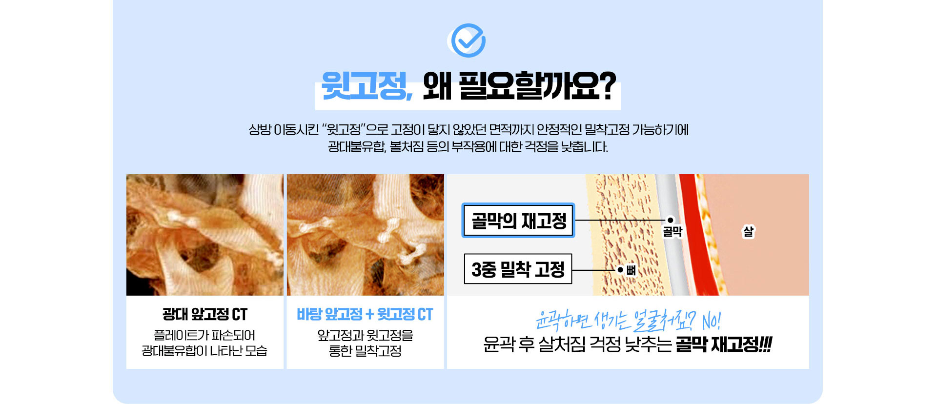 윗고정, 골막의 재고정, 3중밀창고정