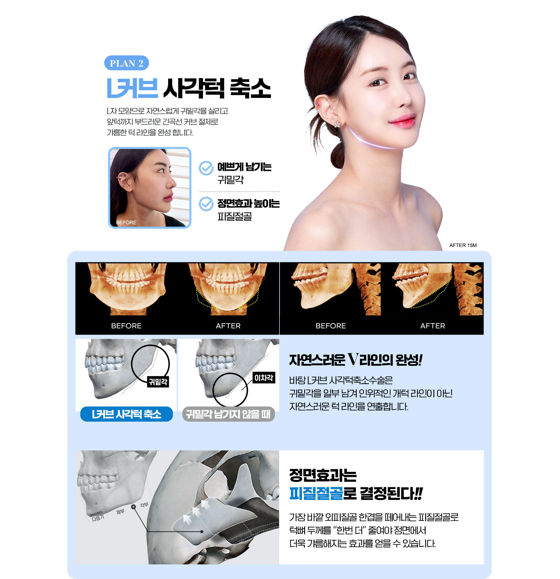 L커브사각턱축소, 예쁘게남기는귀밑각, 정면효과높이는피질절골