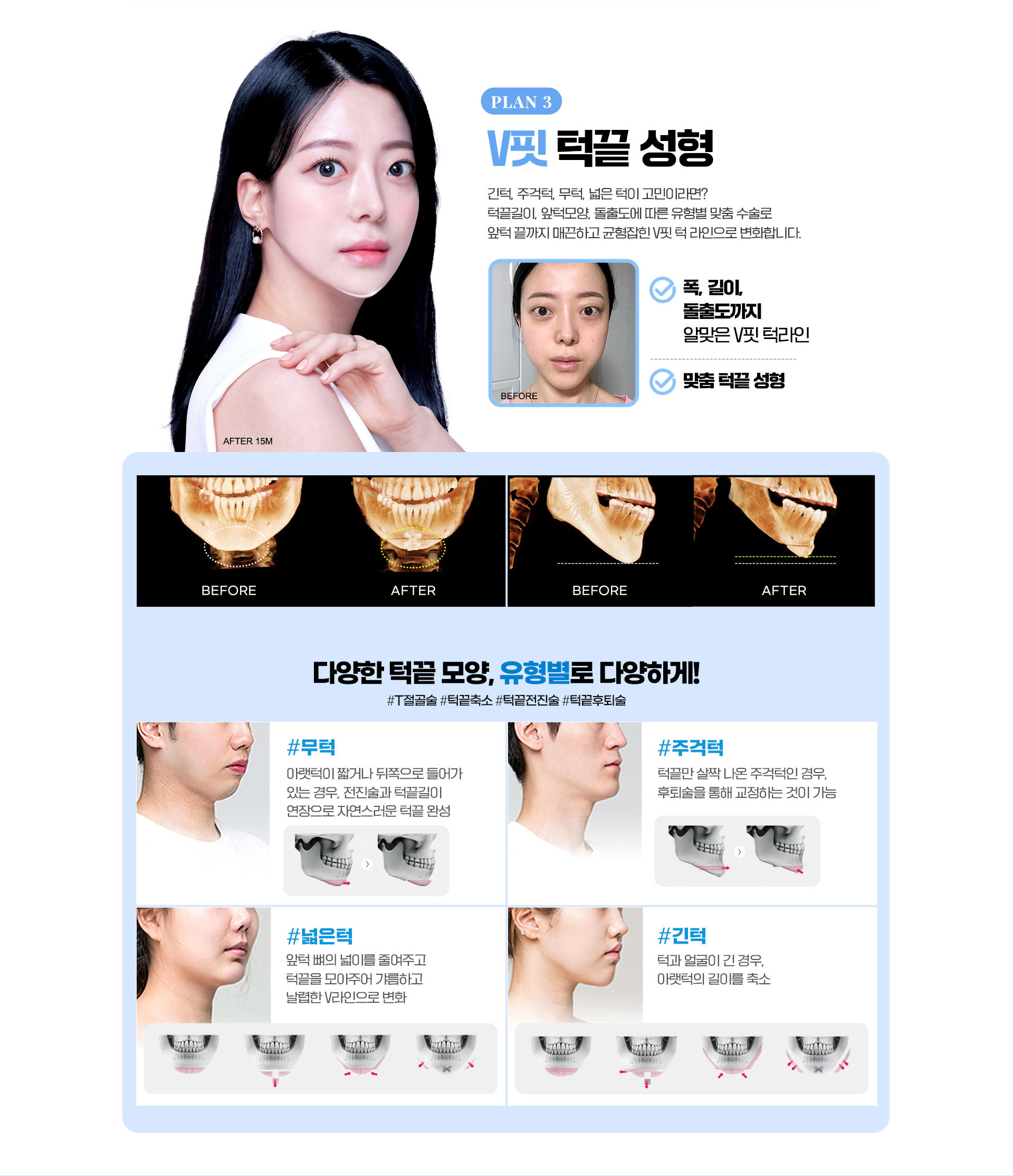 V핏턱끝성형, 폭,길이,돌출도까지알맞은V핏턱라인,맞춤턱끝성형