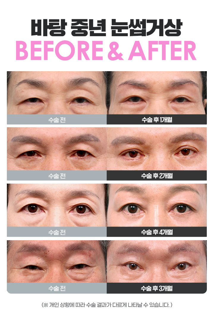 중년눈성형