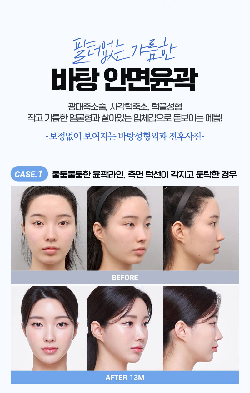 정면각진얼굴로하관이발달한경우