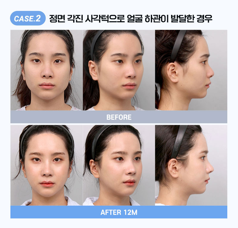 광툭튀, 광대뼈가과도하게발달된경우