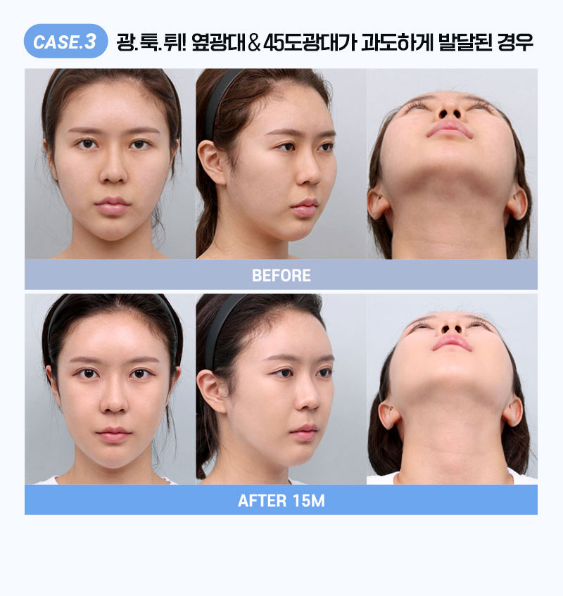 3중밀착고정광대축소,앞뒤윗고정3번의밀착고정,광대불유합다운