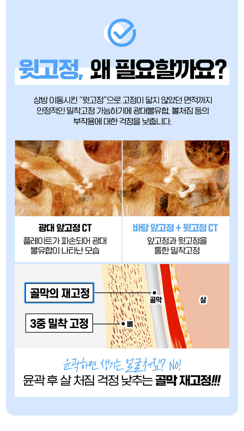 L커브사각턱축소,자연스러운Y라인의완성,정면효과는피질절골로결정된다