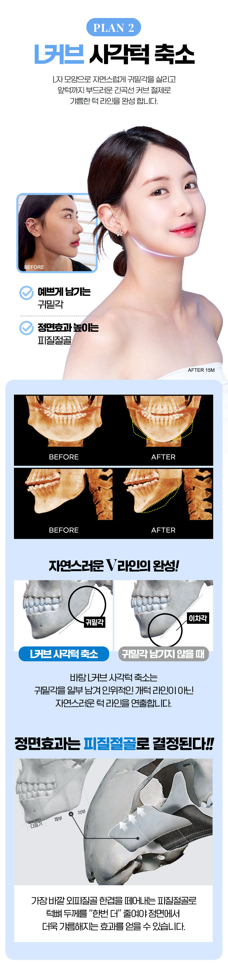 V핏 턱끝 성형, 턱의 폭,길이,비율,돌출도를 고려한 맞춤 턱끝성형